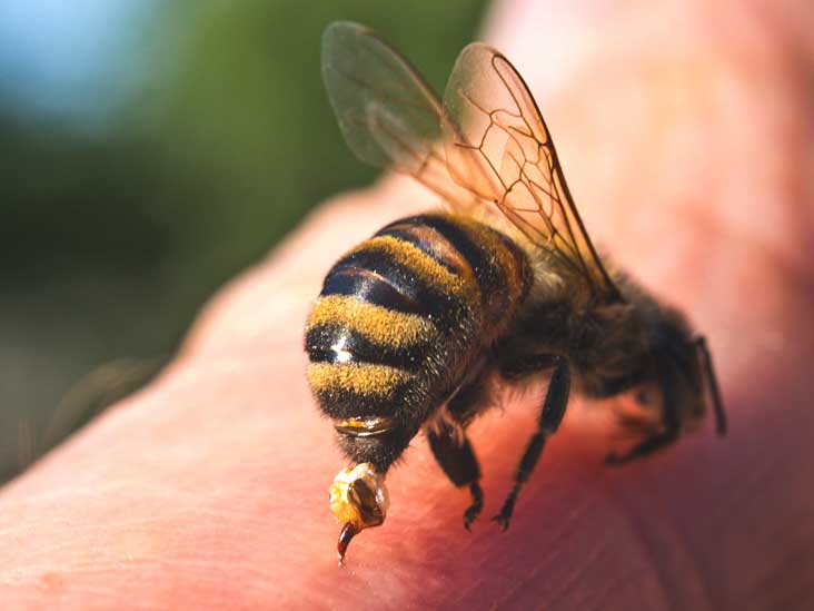 درمان زنبور گزیدگی